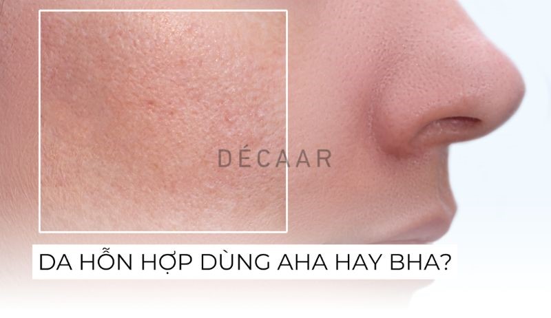 da hỗn hợp nên dùng AHA hay BHA